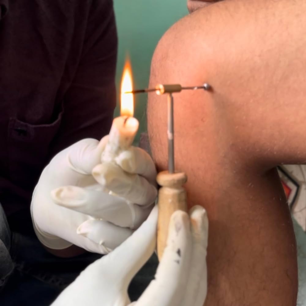 AGNIKARMA & VIDDHAKARMA